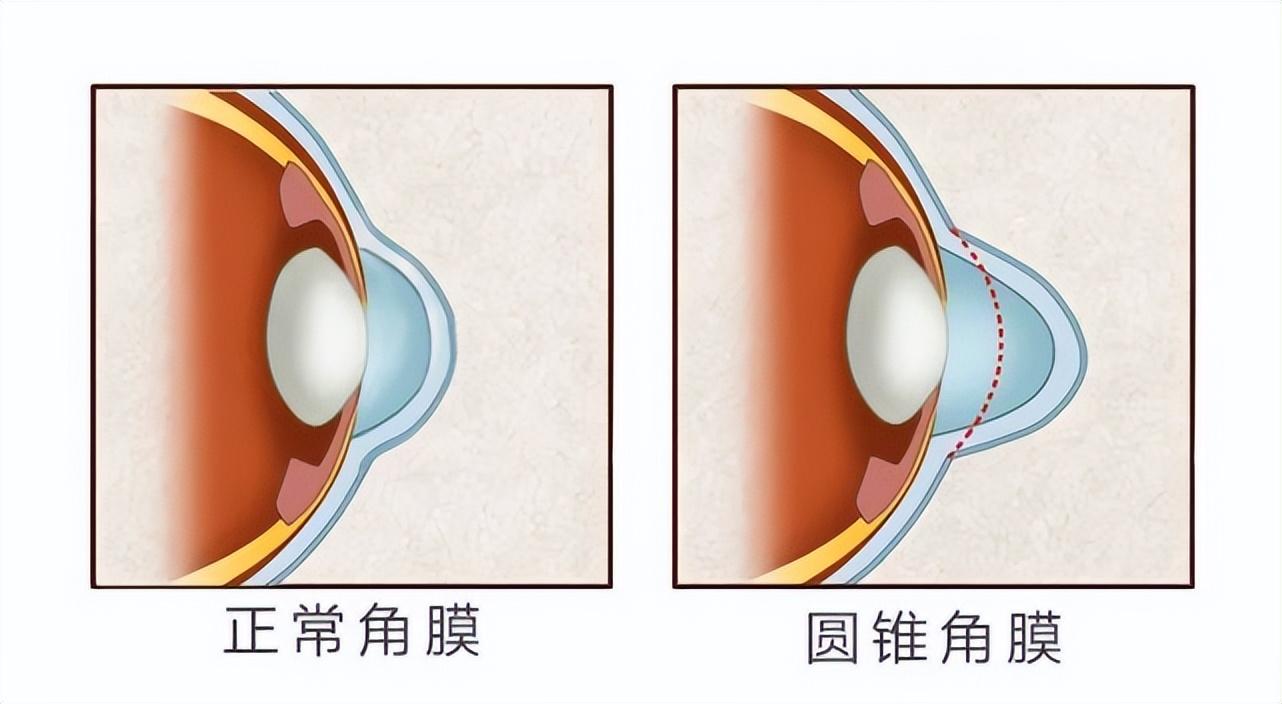 圆锥角膜最新治疗进展及其影响综述