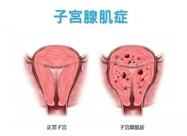 子宫腺肌症最新治疗进展与策略综述